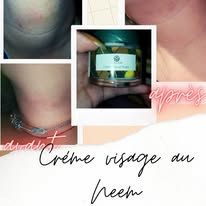 Avant / après de la crème visage au neem sur des rougeurs cutanées